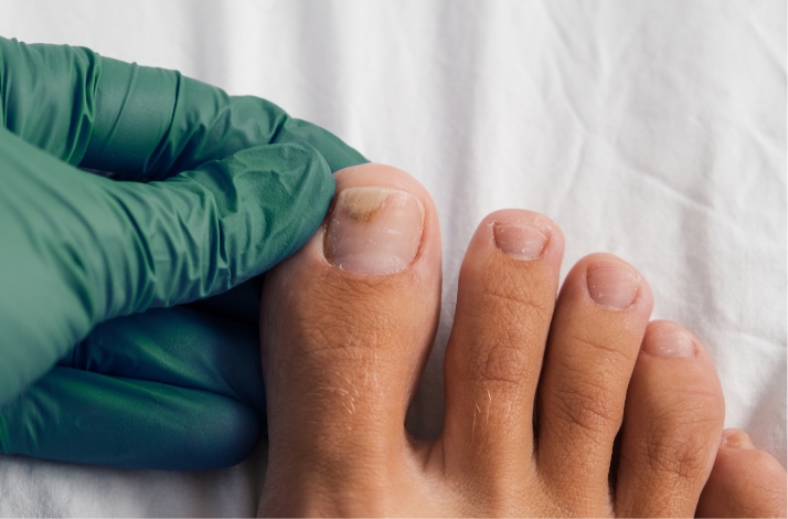 Pourquoi consulter pour un soin podologique